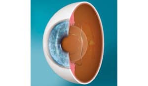 What You Need to Know About ICL Vision Surgery