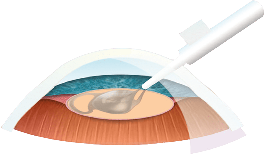 MyVision - Cataract Surgery - Surgery Process - Step 3