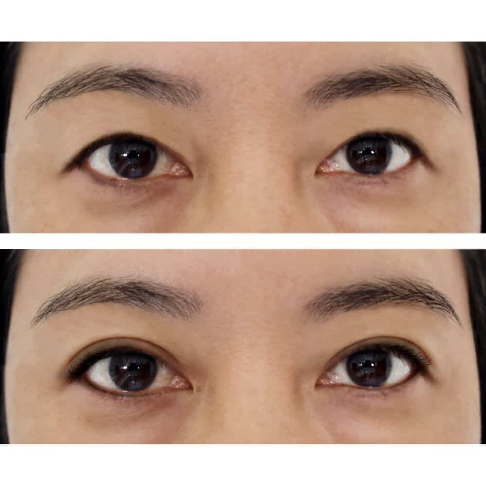 MyVision - Double Eyelid Procedure - Step 5: Results!