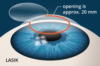 MyVision - Refractive Surgery - LASIK