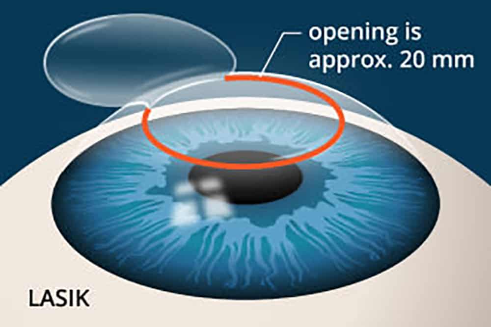 What To Expect During Lasik Surgery